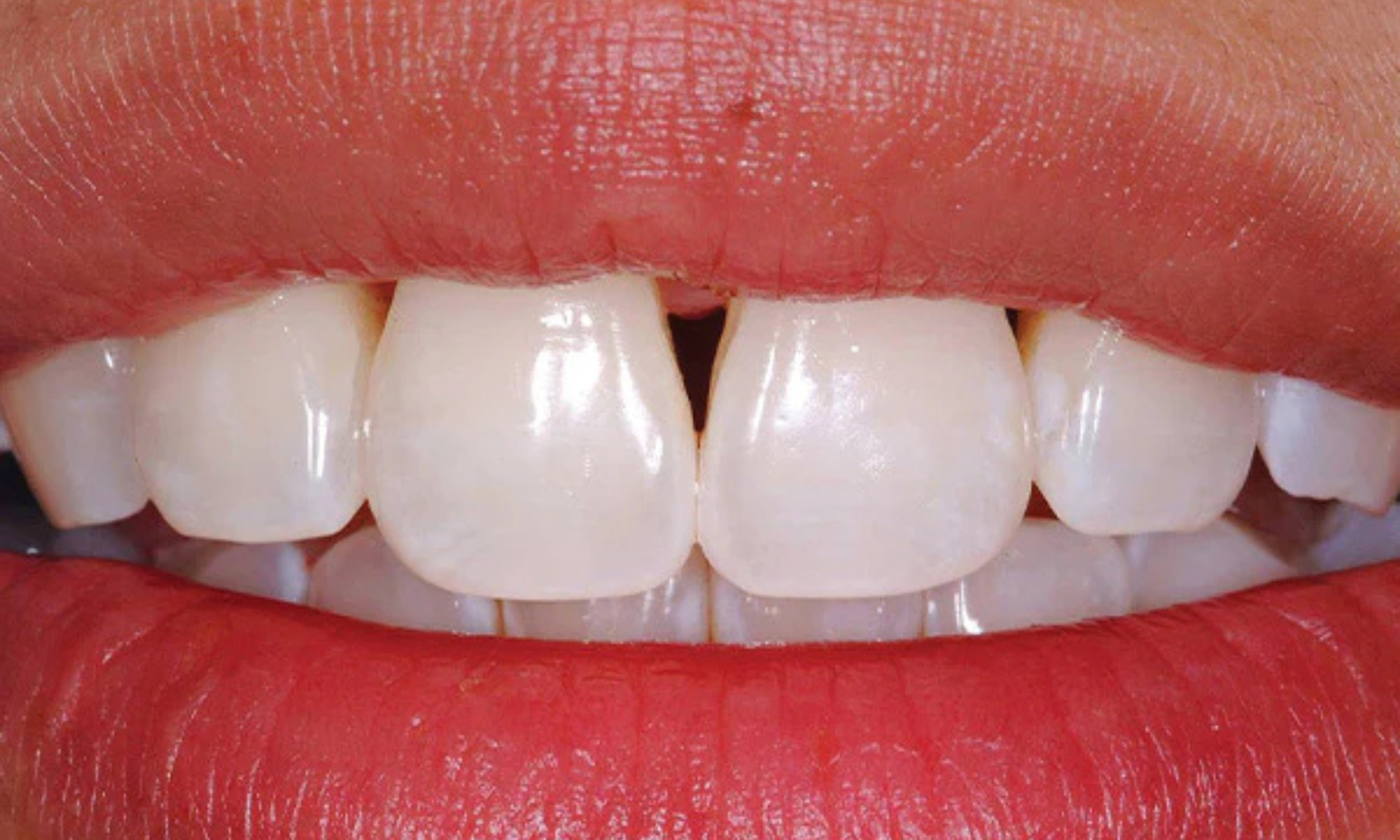 5 razones para elegir Bioclear