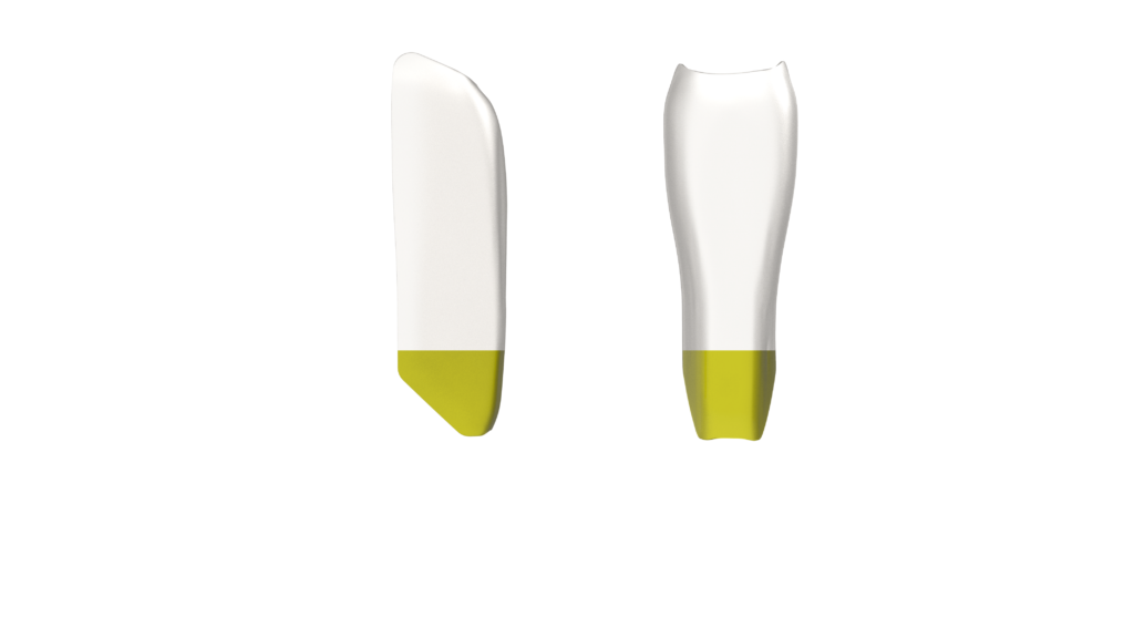 Black Triangle (BT) Anterior Kit